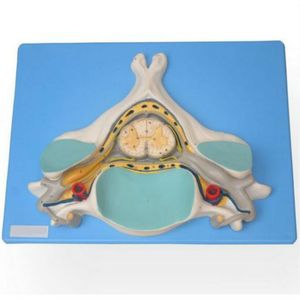Quinta Vertebra Cervical com Medula Espinhal e Nervos