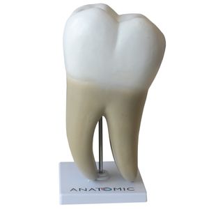 Dente Molar Ampliado 08 Partes com Evolução da Cárie
