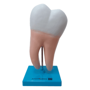 Dente Molar Ampliado - Saudável e com Cáries